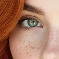 Freckles